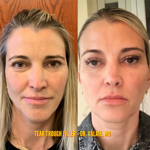 Tear Trough Fillers by Dr. Valaie, MD - Cosmetic Surgeon Newport Beach, Orange County, CA