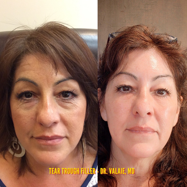 Tear Trough Fillers by Dr. Valaie, MD - Cosmetic Surgeon Newport Beach, Orange County, CA