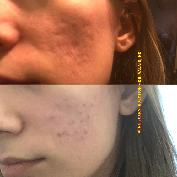  Acne Scar Injection by Dr. Valaie, MD - Cosmetic Surgeon Newport Beach, Orange County, CA