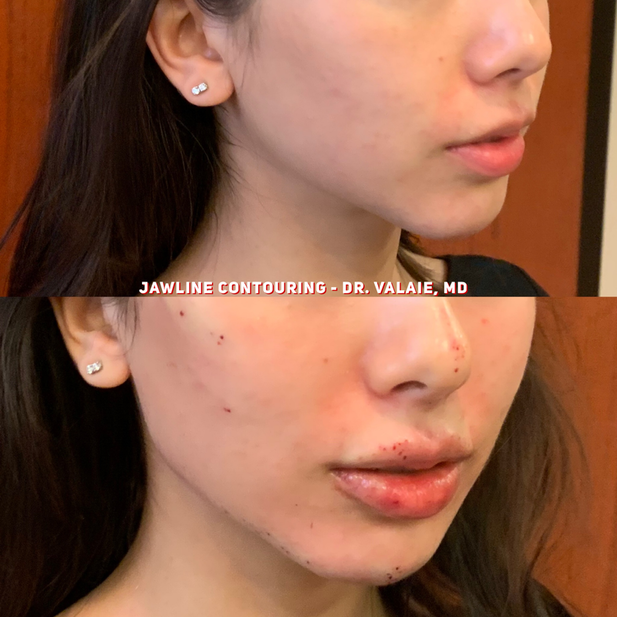 Jawline Contouring by Dr. Valaie, MD - Cosmetic Surgeon Newport Beach,   Orange County, CA