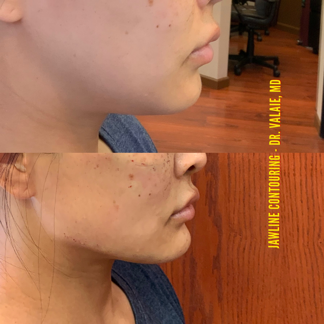 Jawline Contouring by Dr. Valaie, MD - Cosmetic Surgeon Newport Beach, Orange County, CA