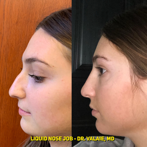 Liquid Nose Job by Dr. Valaie, MD - Cosmetic Surgeon Newport Beach,   Orange County, CA
