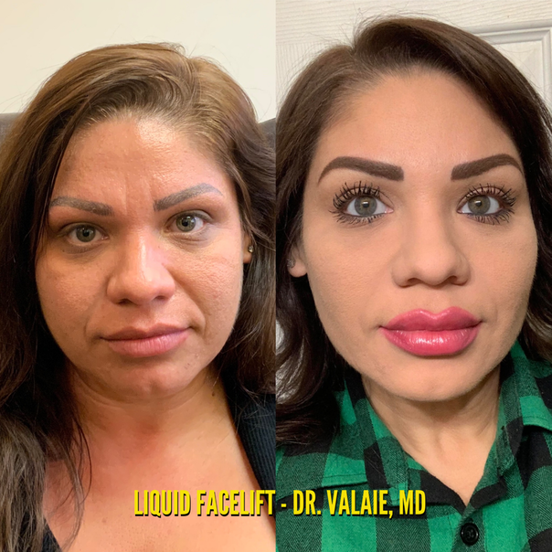 Liquid Facelift by Dr. Valaie, MD - Cosmetic Surgeon Newport Beach,   Orange County, CA