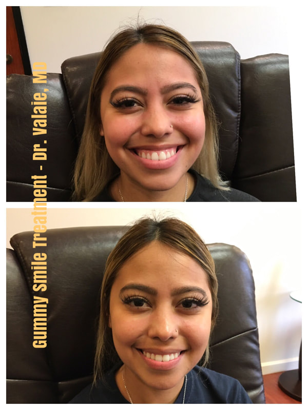 Nose Fillers by Dr. Valaie, MD - Cosmetic Surgeon, Newport Beach, CA