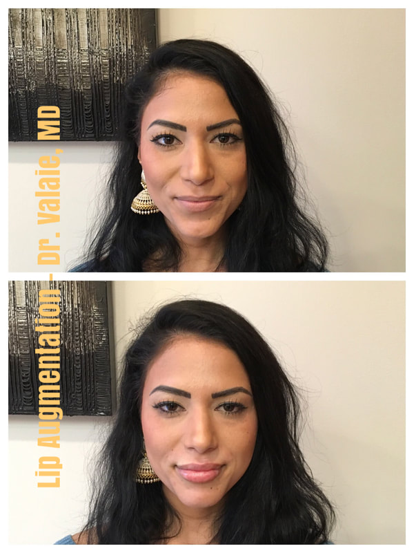 Lip Filler injection by Dr. Valaie, MD using Juvederm Ultra XC at Newport Beach, Orange County, CA