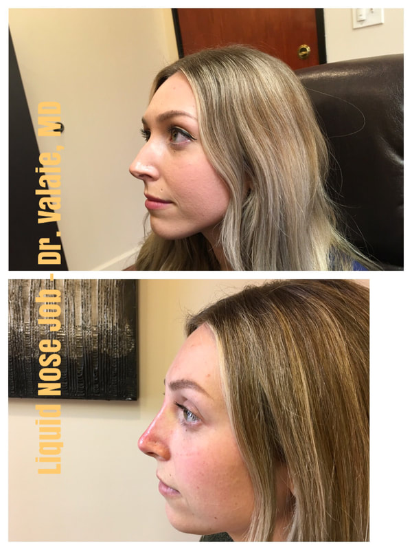 Nose Filler Injection using Restylane by Dr. Valaie, MD