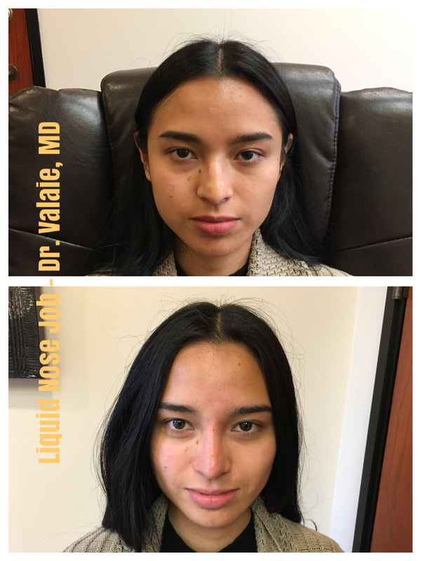 Liquid Nose Job using Restylane dermal fillers by Dr. Valaie, MD Cosmetic Surgeon, Newport Beach, Orange County CA 